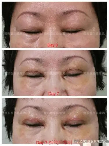 59岁女性双眼皮手术术后7天看起来有神多了