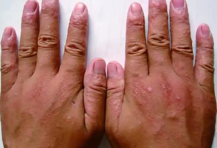 易误诊的癣菌疹_癣_介绍_症状表现_治疗方式 - 好大夫在线