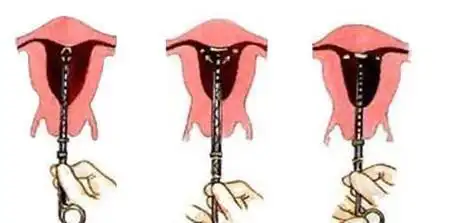 生完孩子就开始上环?看看过来人是怎么说,免受痛苦