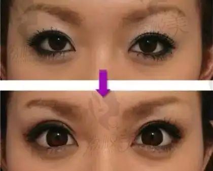 眼睑下至和外眼角手术帮助你成就卡姿兰大眼睛_荔枝美