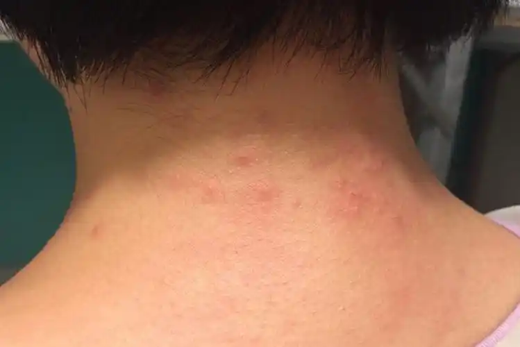 螨虫过敏的症状图