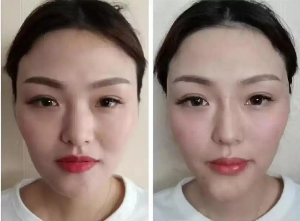 自体脂肪填充后为什么效果不理想?还能修复吗?术后怎么护理合适