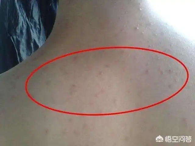 头条问答 - 前胸和后背有可以挤出像黑头一样白色的东西?为什么?