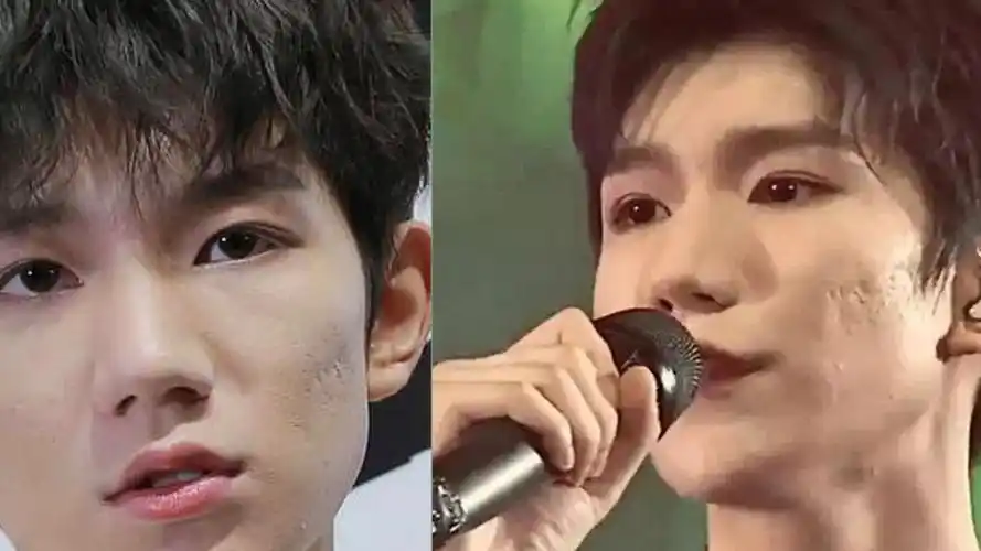 王源险些"烂脸"毁容?镜头下真实颜值曝光,网友:别抽烟了!