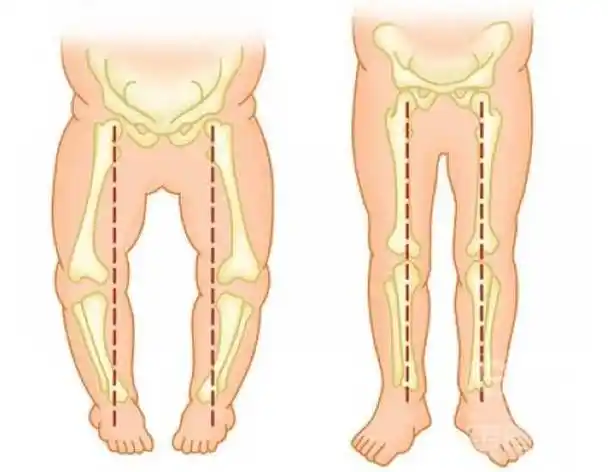 内八字(不良的走路习惯)_摘编百科