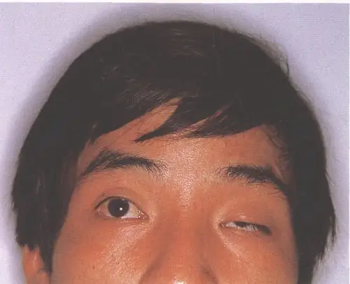 (图) 左侧先天性上睑下垂
