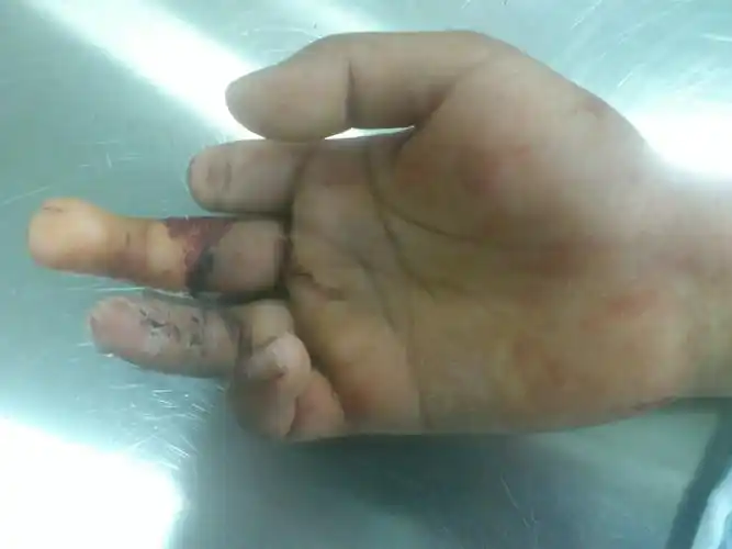 手指再造有哪几种方法