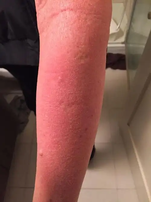 爷爷手臂上莫名其妙的发出了这个,有十天了,开始的时候就是手臂上一小