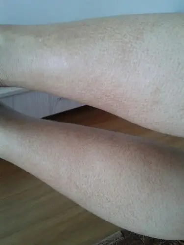 问:  g****** 女40岁|分类:皮肤性病科1 小时前 1 分钟前蒋康伦