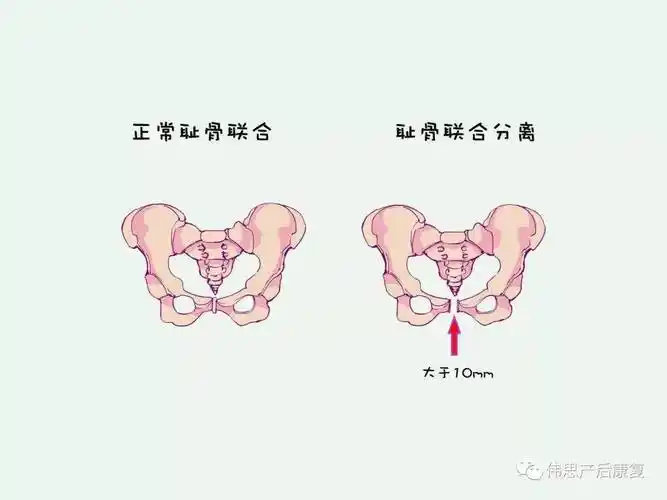 产康课堂产后骨盆前倾骨盆后倾骨盆侧弯什么鬼