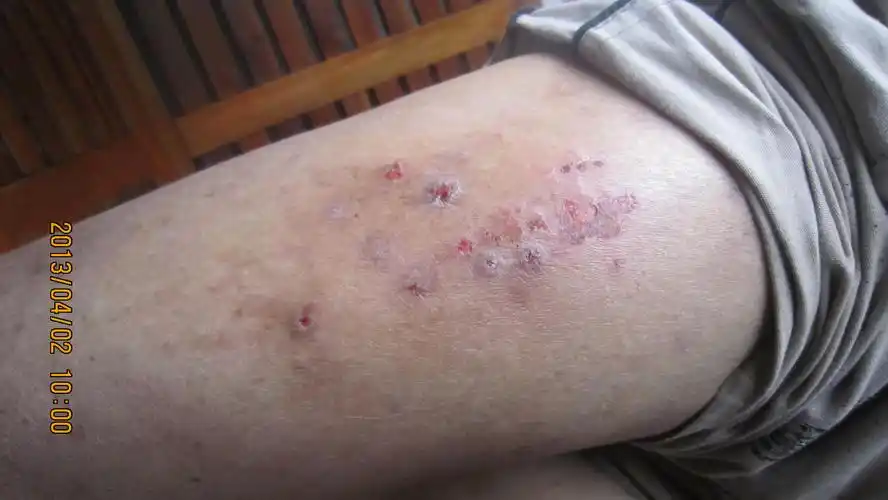 看图诊断湿疹-----《春季皮肤病病例征集》