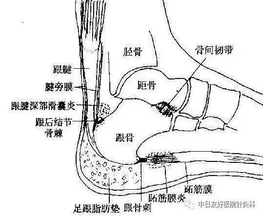脚底痛到底是什么病