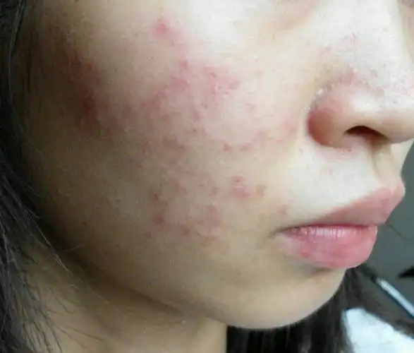 皮肤屏障受损为什么夏天更严重?皮肤屏障是什么?