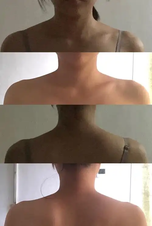 周六野斜方肌坚持一周对比讲真好像有点用野