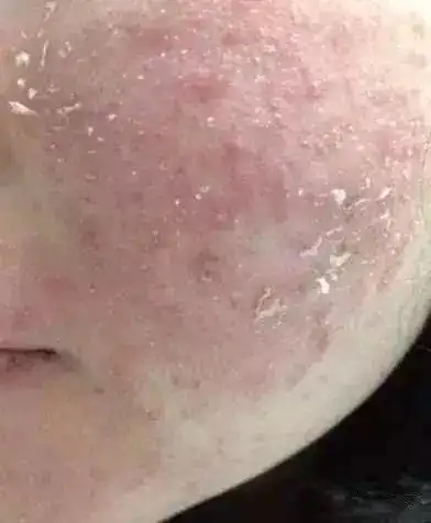 皮肤屏障受损所带来的皮肤问题