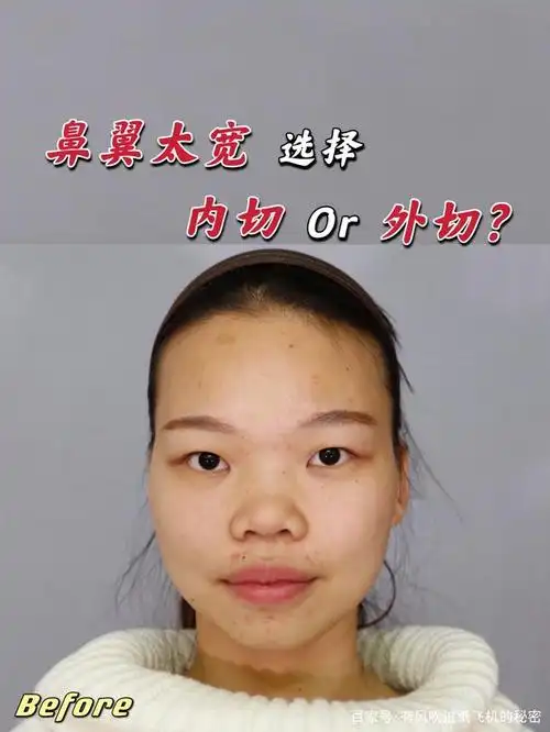 鼻翼宽大该怎么改善?
