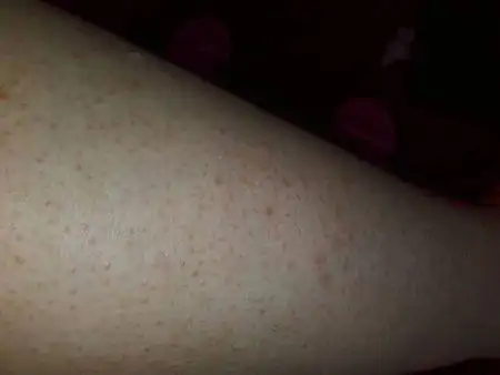 慎点】小腿皮肤上常年有一些小颗粒(不痒也不痛),是因为毛孔堵塞吗?