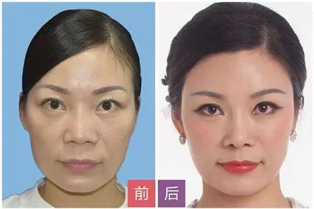 面部整形前后对比