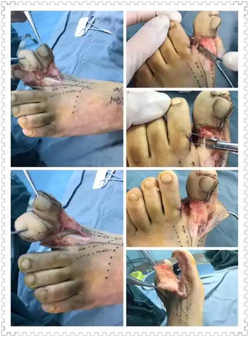 "---记我院首例保留足趾的拇指再造术