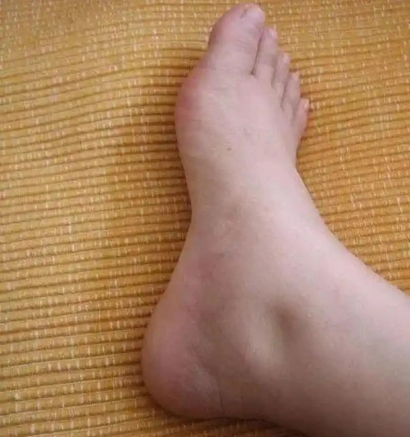 14岁的小志是一名初中学生,该患儿于去年9月底因颜面及双下肢水肿