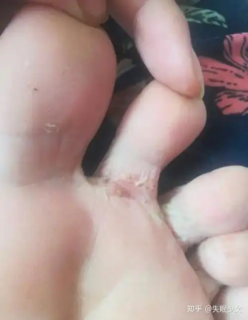 女学生脚气怎么办?