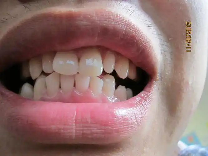 有什么危害 我有四颗牙长得有点长 有点尖.想磨平.