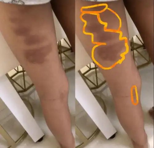 佛山8岁男生遭宿管员衣架击打致伤家长不满而投诉通报来了