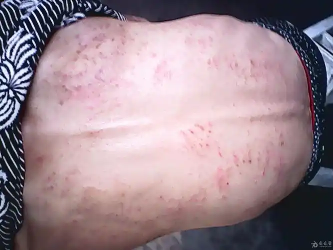 背部,双胳膊皮疹一月 - 皮肤及性传播疾病讨论版 - 爱爱医医学论坛