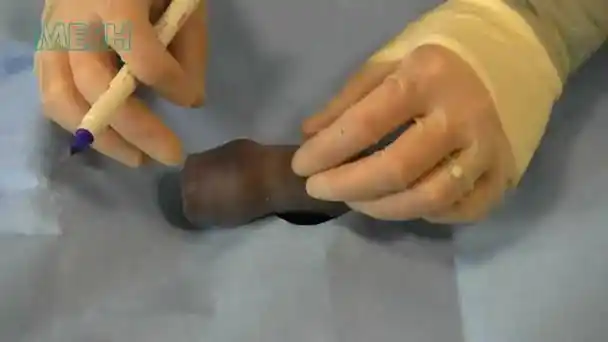 使用模型进行包皮环切术教学