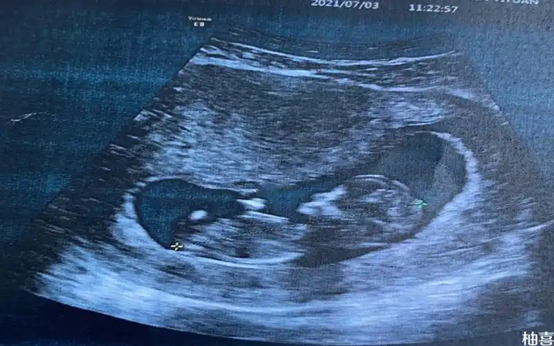 nt图像上有三个点是怀女孩的概率更高吗