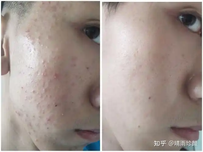 这种痘痘皮肤该怎么办啊
