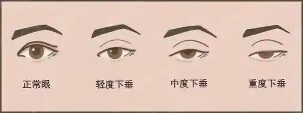 大小眼?肌无力!上睑下垂治疗需手术|瞳孔|眼睑下垂