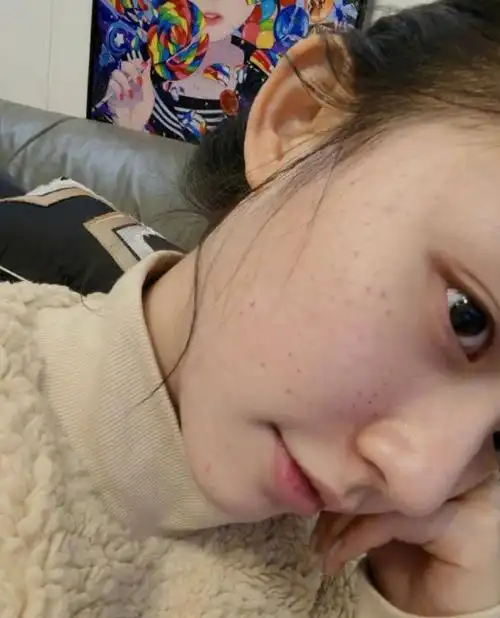 星女郎林允白嫩左脸满是针眼密密麻麻好吓人为了变美也太拼了