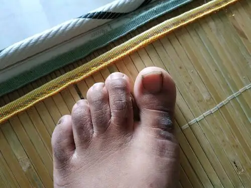 脚趾上有黑色的东西是什么,怎么治疗