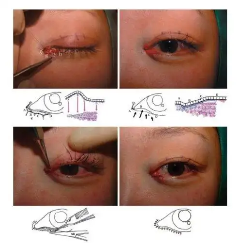 开内眼角手术误区只是切除多余的皮