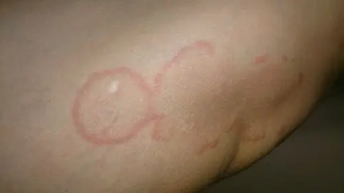 问:团状红斑,稍微有痒感,最大的有5mm,边缘稍微凸起.