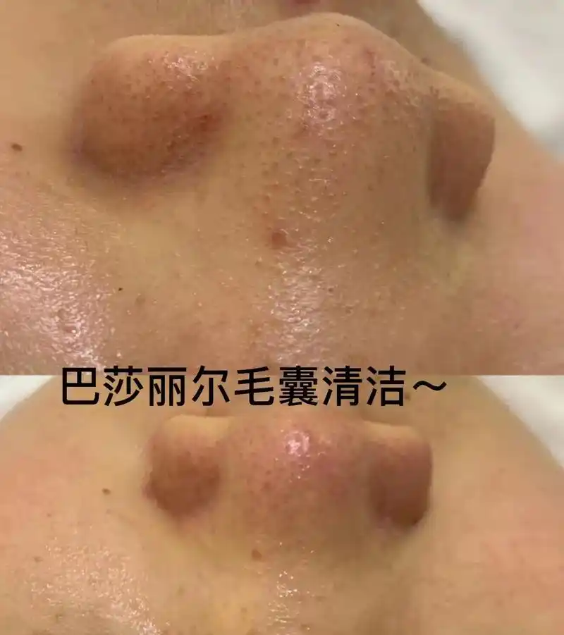 毛囊清洁 #痘痘黑头粉刺拜拜 #解决任何皮肤问题 #好皮肤 - 抖音