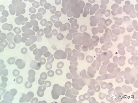 面对一份「高冷」的红细胞凝集标本,你会如何处理?