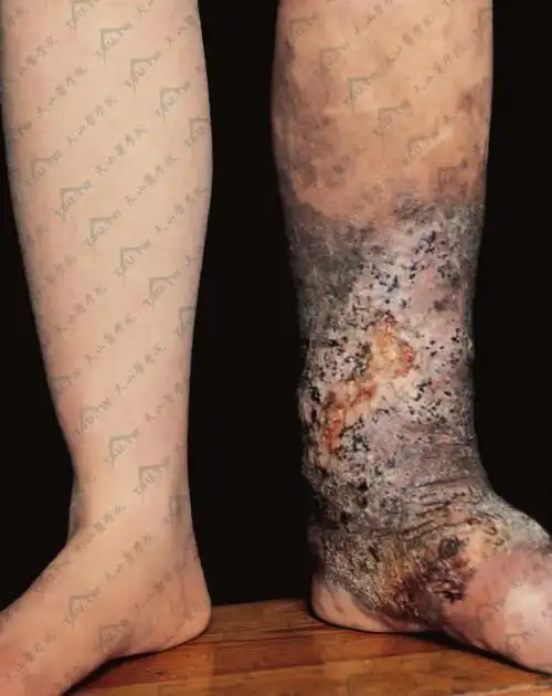 左小腿中段至足背呈象皮肿样,上段棕褐色,下段至足背为褐色和黑色