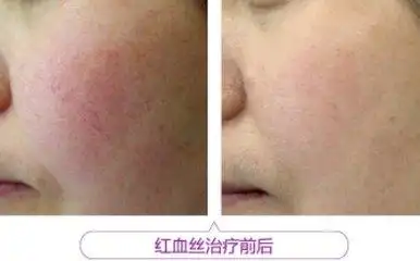 祛除红血丝前后对比