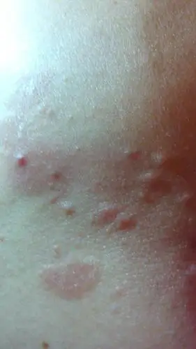 问:这是荨麻疹,湿疹,还是过敏啊,手背上,胳膊上,肚皮上,大腿上,背上长