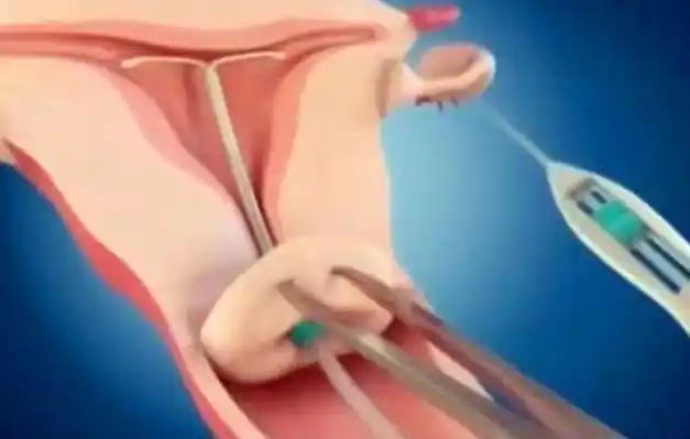 2,女性做上环手术对身体有什么危害