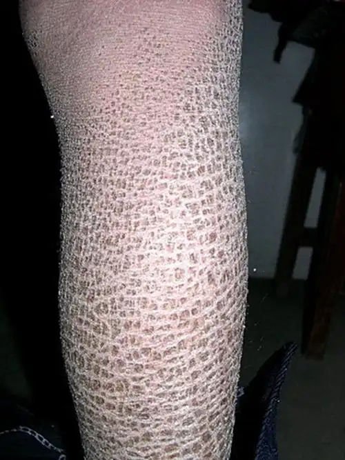 角样鱼鳞病图片_有来医生