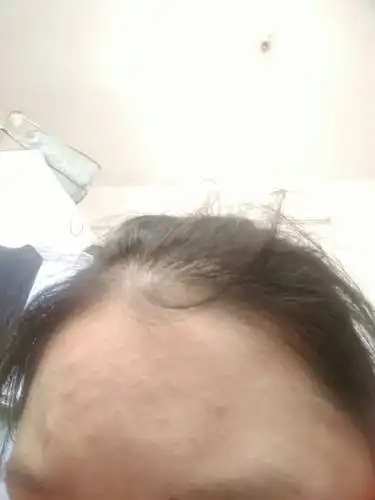 毛孔粗大,堵塞,毛孔里很多脏东西,怎么弄啊