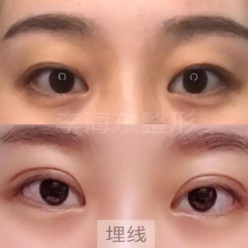 埋线三点定位和全切双眼皮的区别