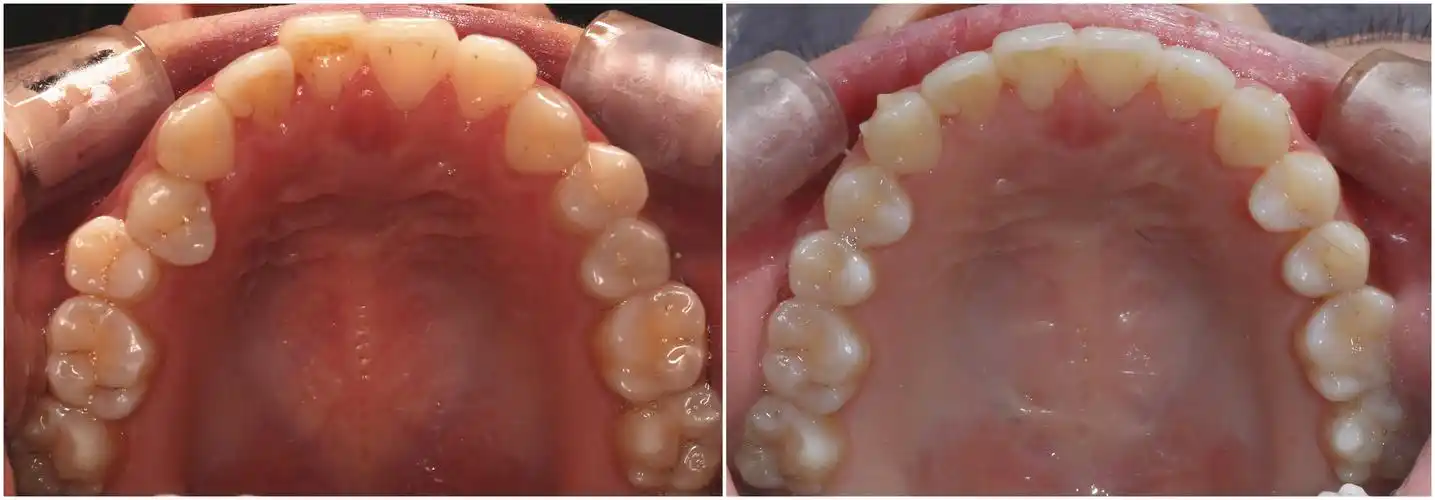 反颌跟开颌未解除检查结果:前牙反颌,开颌,磨牙反颌,上颌牙弓卵圆形