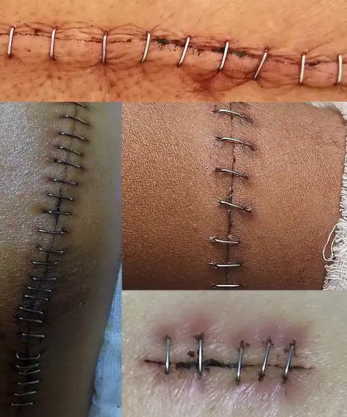 开颅等外科手术后伤口拆钉器专用皮肤取钉器起钉器割包皮术后拆钉器