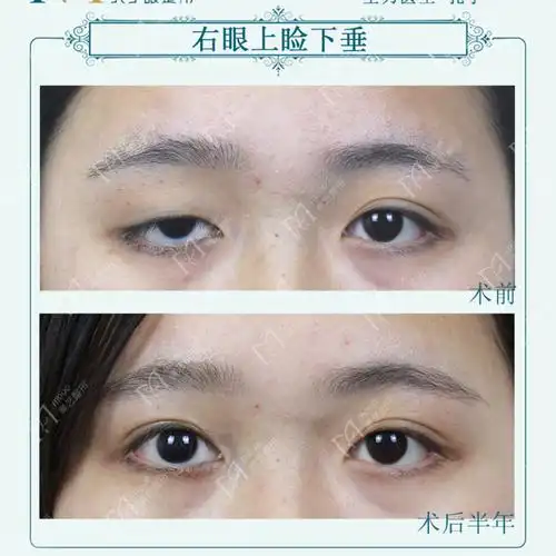 姑娘是右眼先天性上睑下垂,左眼正常,两只眼睛差别很