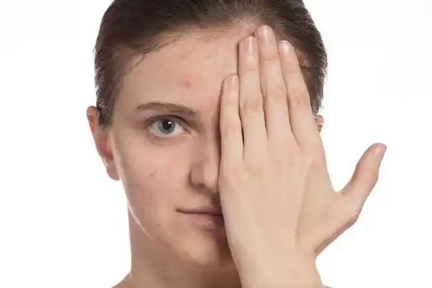 困扰多年的皮肤问题,竟因戒掉奶茶而"消失"了,不妨看看原因