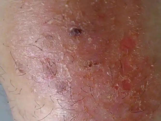 问题:手上,腿上,肘部有一片的硬皮,很痒,一抓还掉皮,有出血点